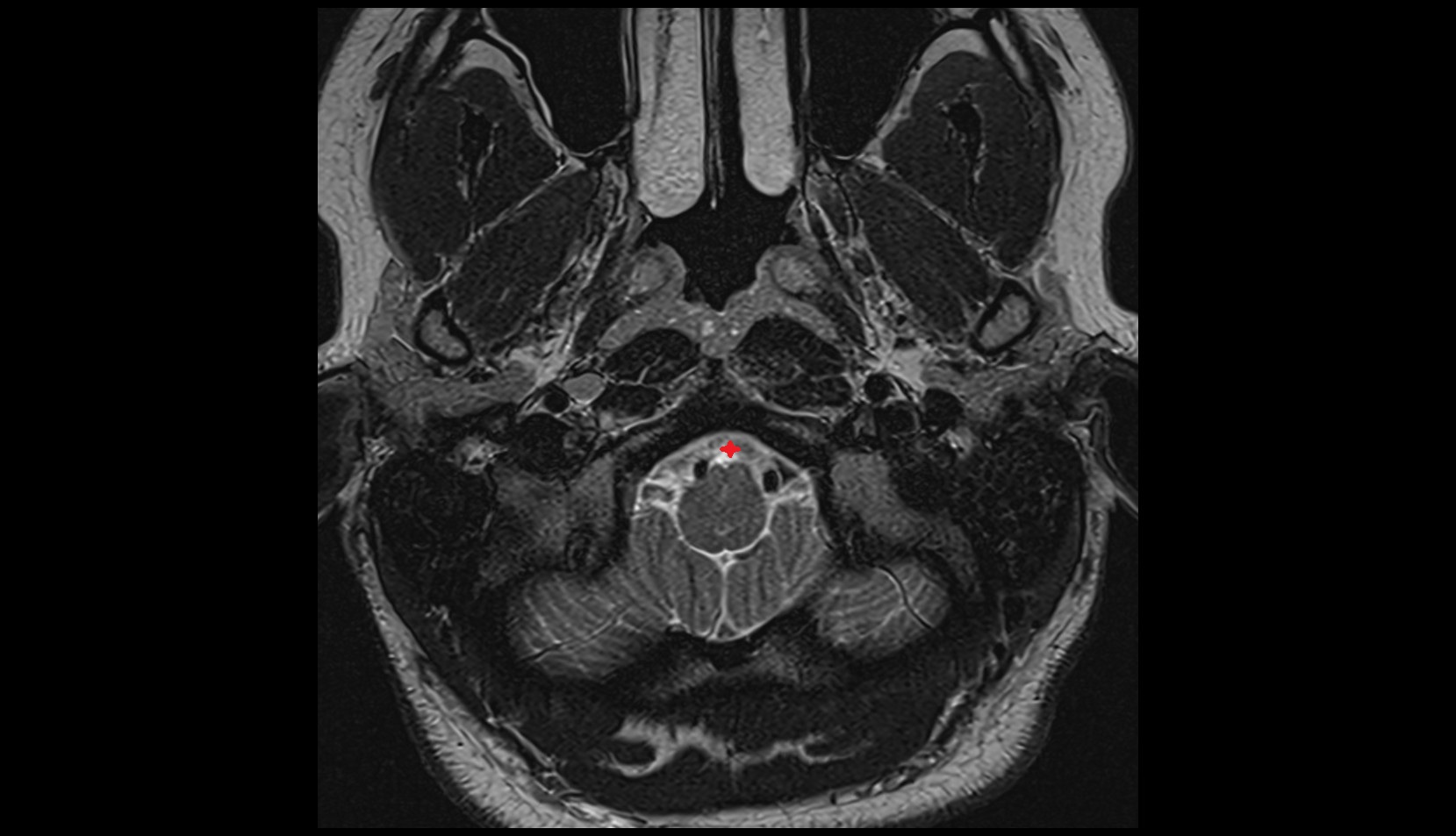 Premedullary cistern,