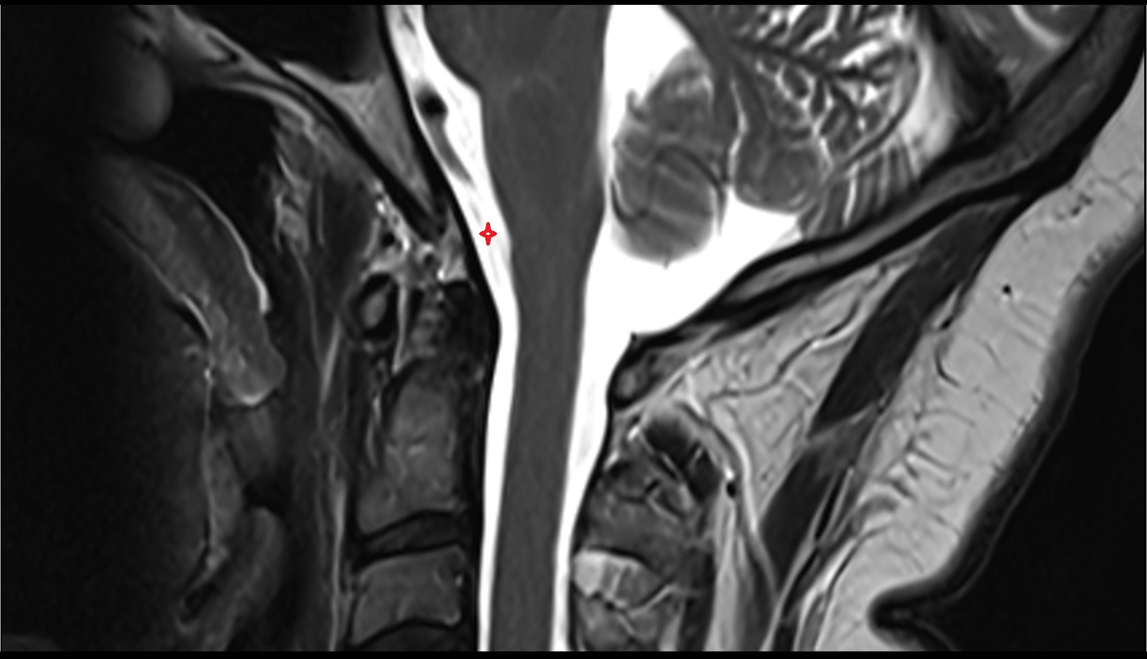 Premedullary cistern mri sag image