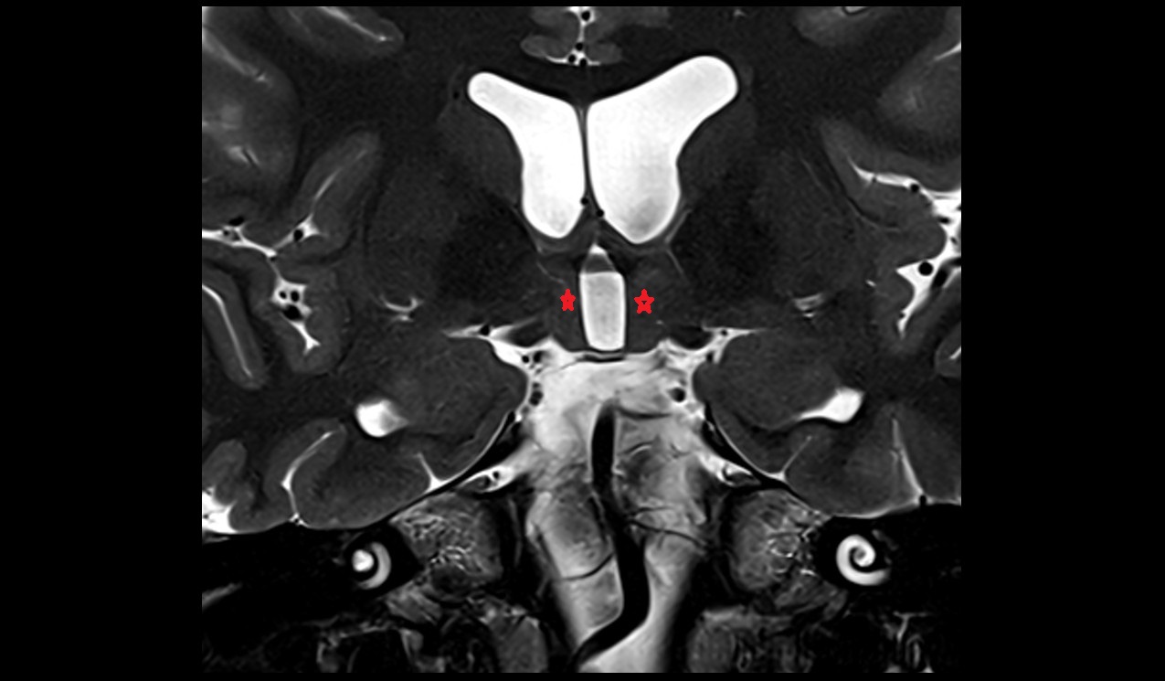 Preoptic area mri 3t coronal image