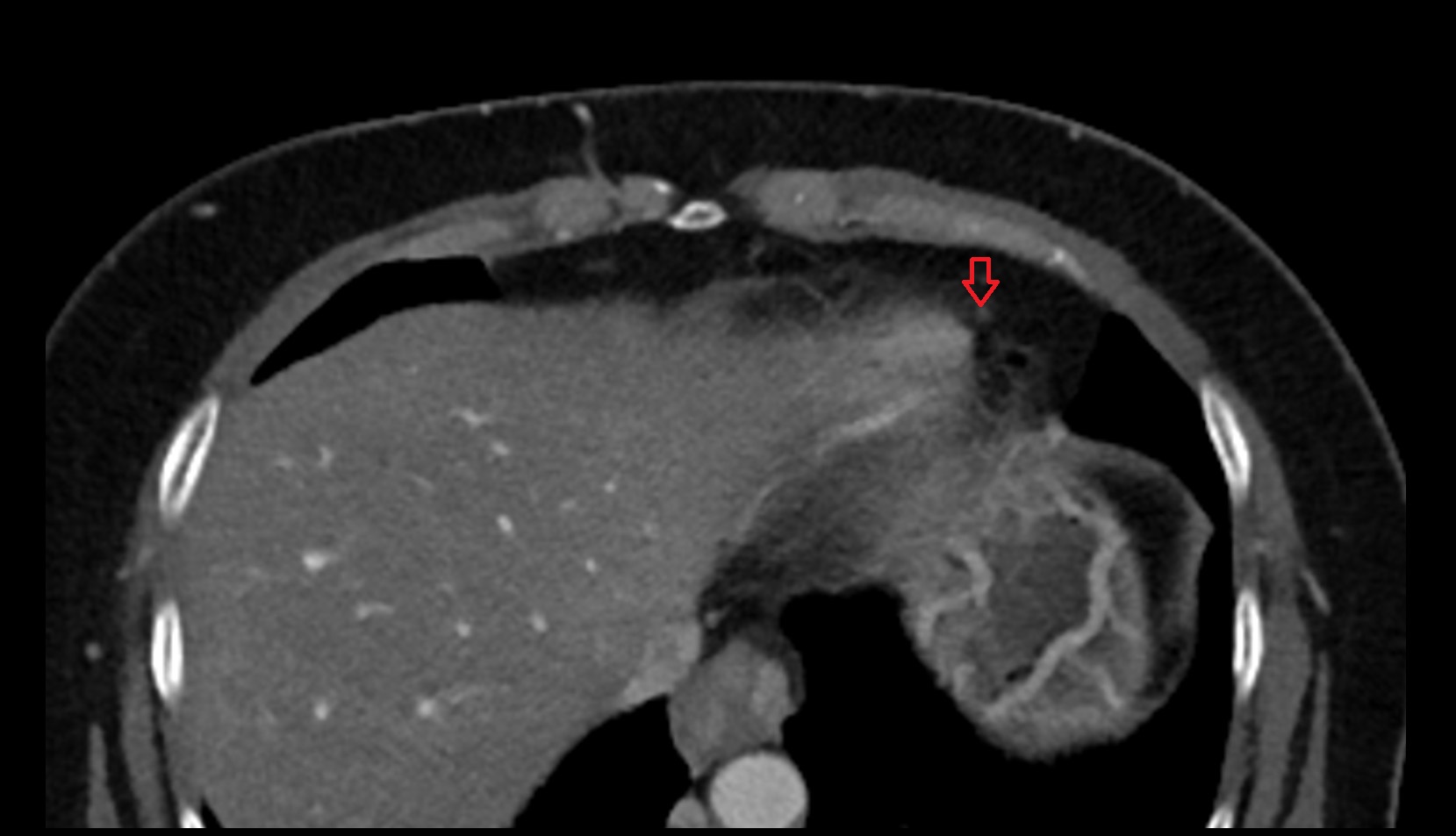 Prepericardial lymph nodes  CT AXIAL image anatomy