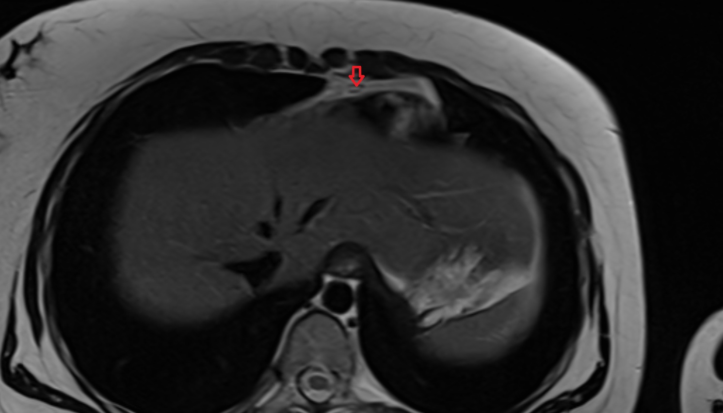 Prepericardial lymph nodes  MRI AXIAL image anatomy  image -img-00000-00000