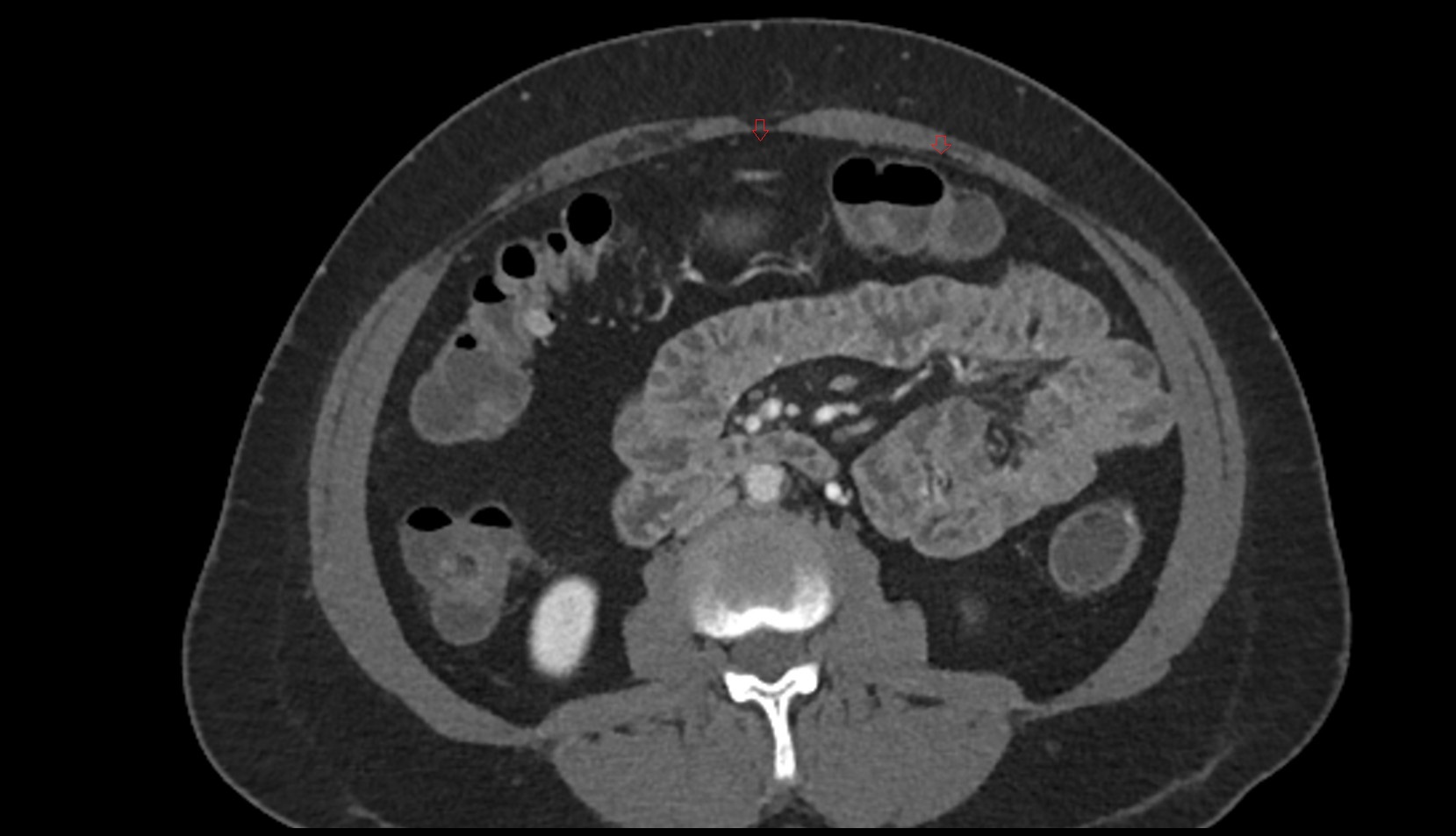 Preperitoneal space CT axial image