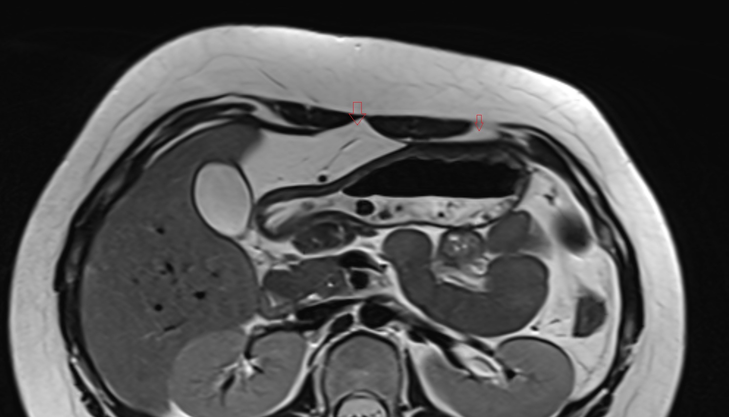 Preperitoneal space  MRI axial  anatomy  image-img-00000-00000_00001