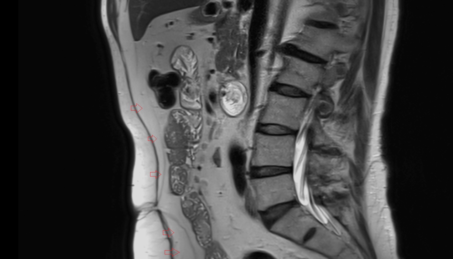 Preperitoneal space  MRI sag  anatomy  image-img-00000-00000_00001