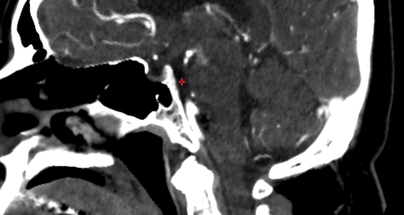 Prepontine cistern  CT sag anatomy image -img-00001-00001