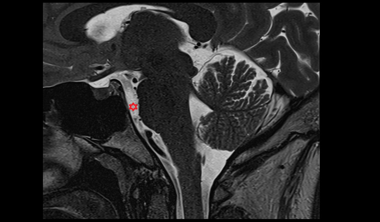 Prepontine cistern mri 3t sagittal image