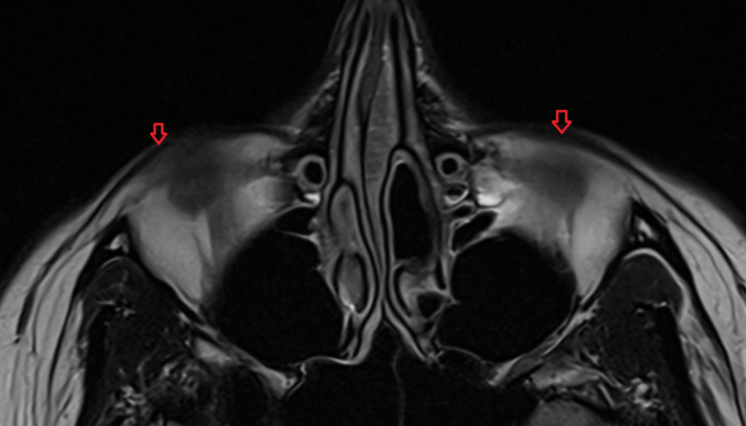 Preseptal part of orbicularis oculi muscle mri axial image -img-00000-00000