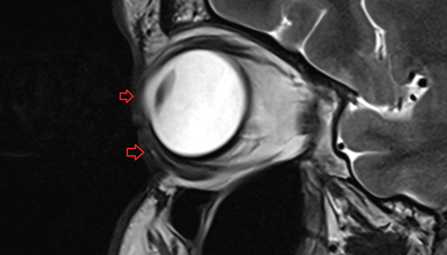 Preseptal part of orbicularis oculi muscle mri axial image -img-00000-00000_00001