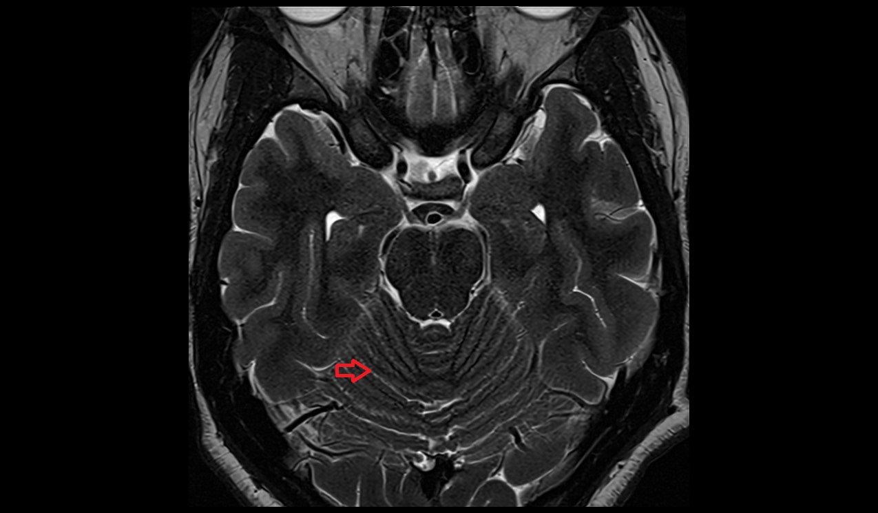 Primary fissure MRI 3T axial image