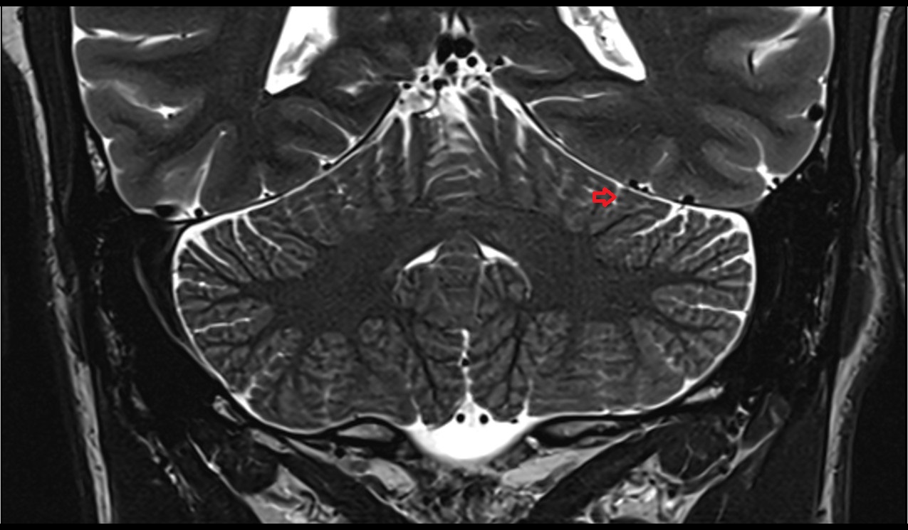 Primary fissure MRI 3T coronal image