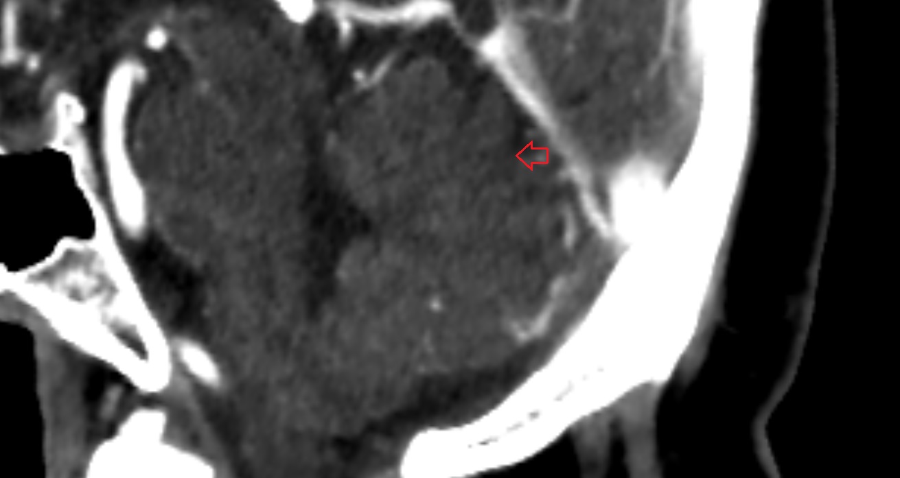 Primary fissure of cerebellum  CT sag  anatomy image -img-00001-00001