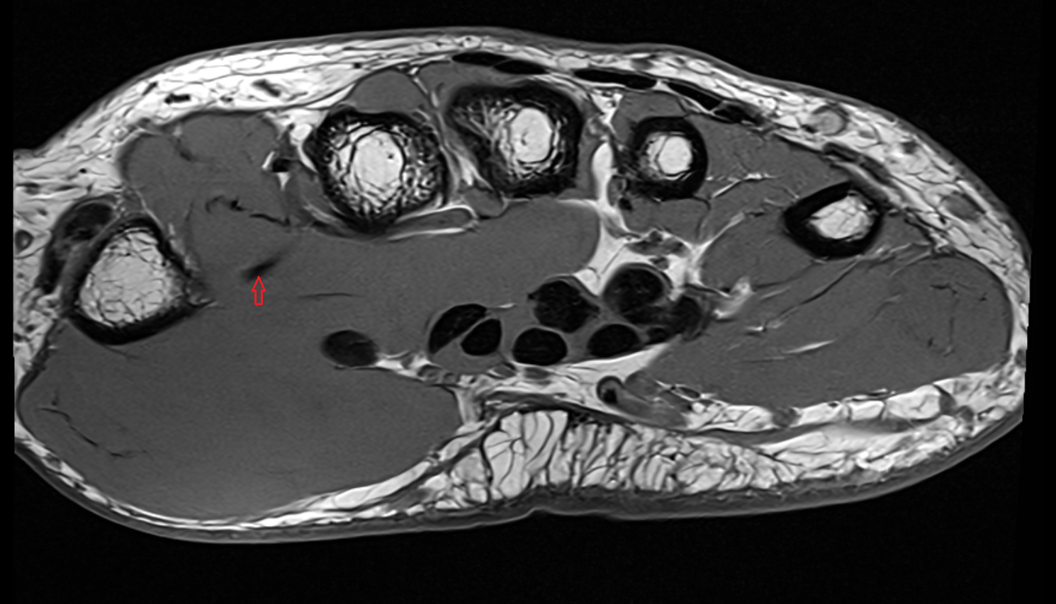Princeps pollicis artery  axial cross sectional anatomy 3T MRI AI enhanced radiology image-img-00000-00000