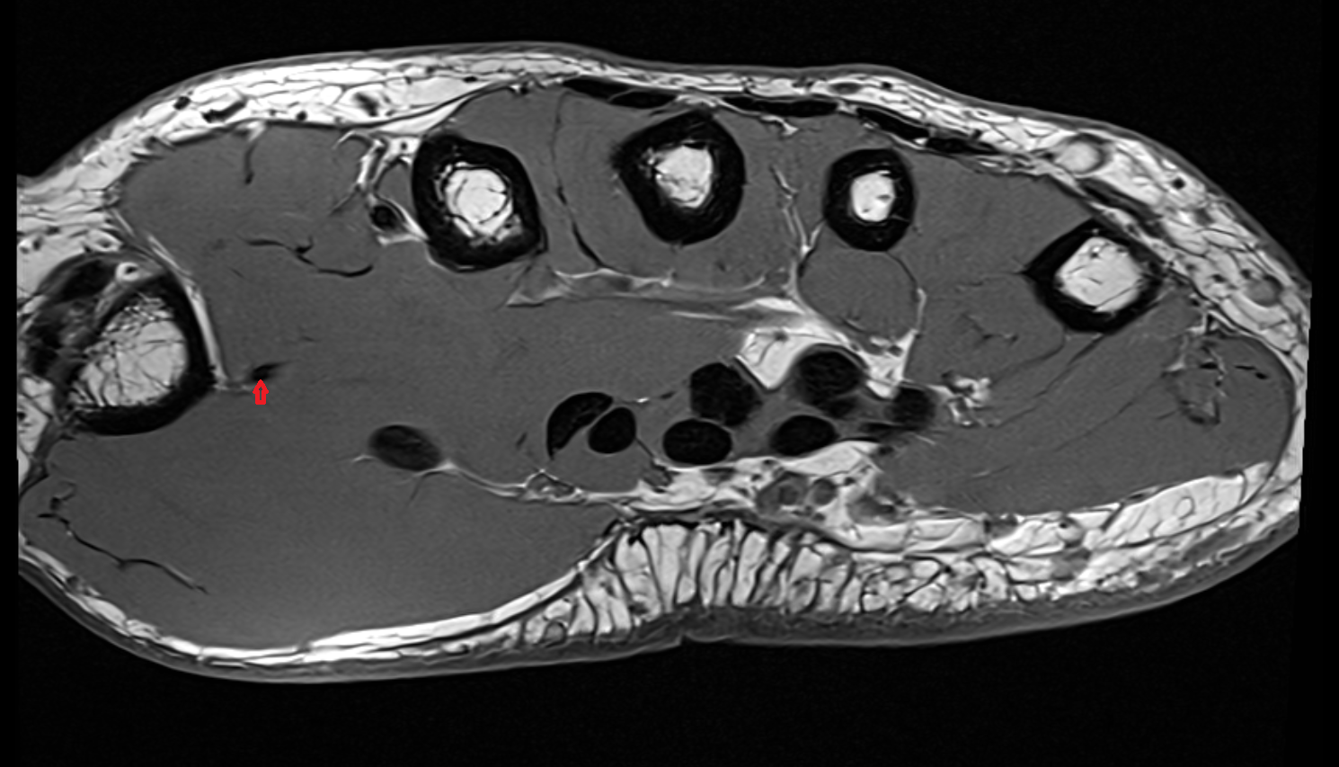 Princeps pollicis artery  axial cross sectional anatomy 3T MRI AI enhanced radiology image-img-00000-00000_00001