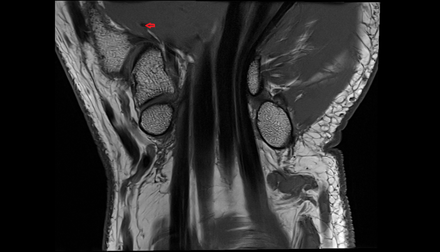 Princeps pollicis artery  axial cross sectional anatomy 3T MRI AI enhanced radiology image-img-00000-00000_00002