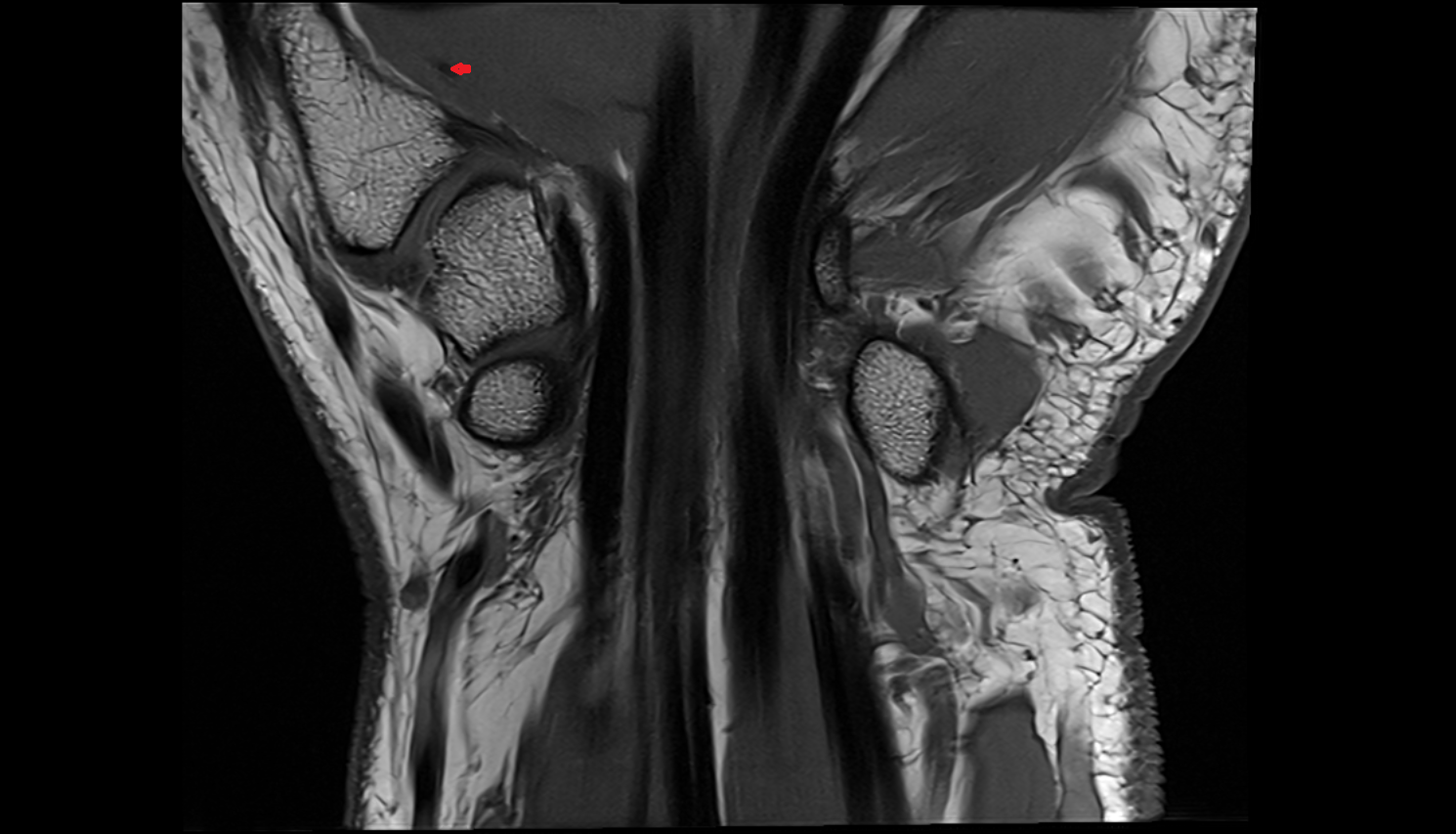 Princeps pollicis artery  axial cross sectional anatomy 3T MRI AI enhanced radiology image-img-00000-00000_00003