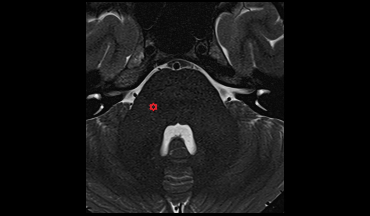 Principal sensory nucleus of trigeminal nerve MRI 3T image