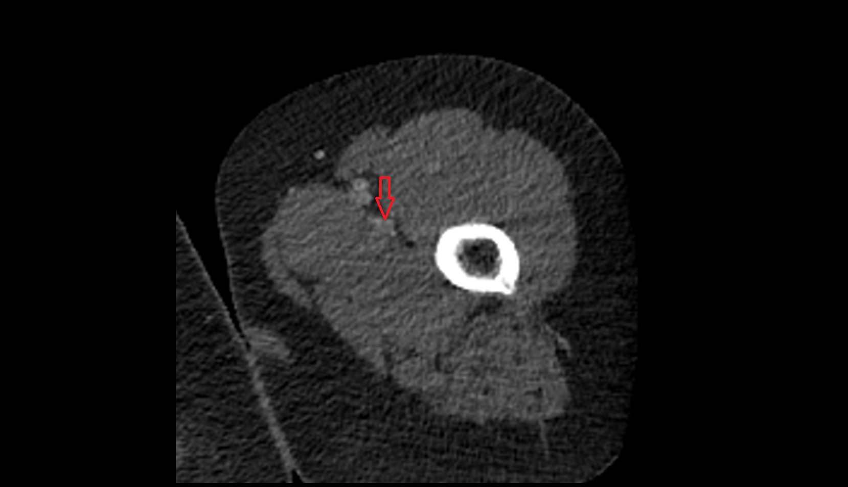 Profunda femoris (deep femoral) vein 0