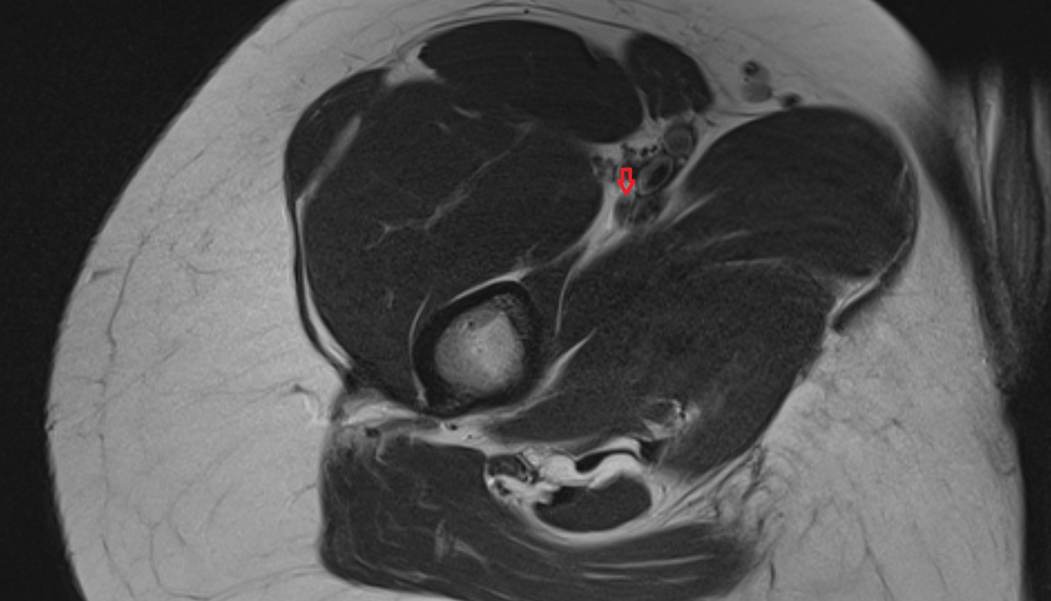 Profunda femoris (deep femoral) vein MRI axial  anatomy image-img-00000-00000