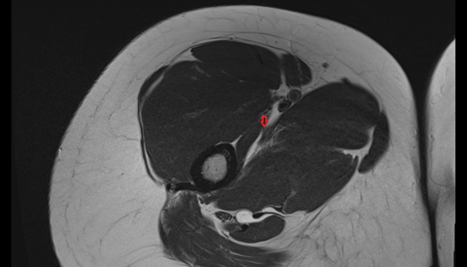 Profunda femoris (deep femoral) vein MRI axial  anatomy image-img-00000-00000_00001