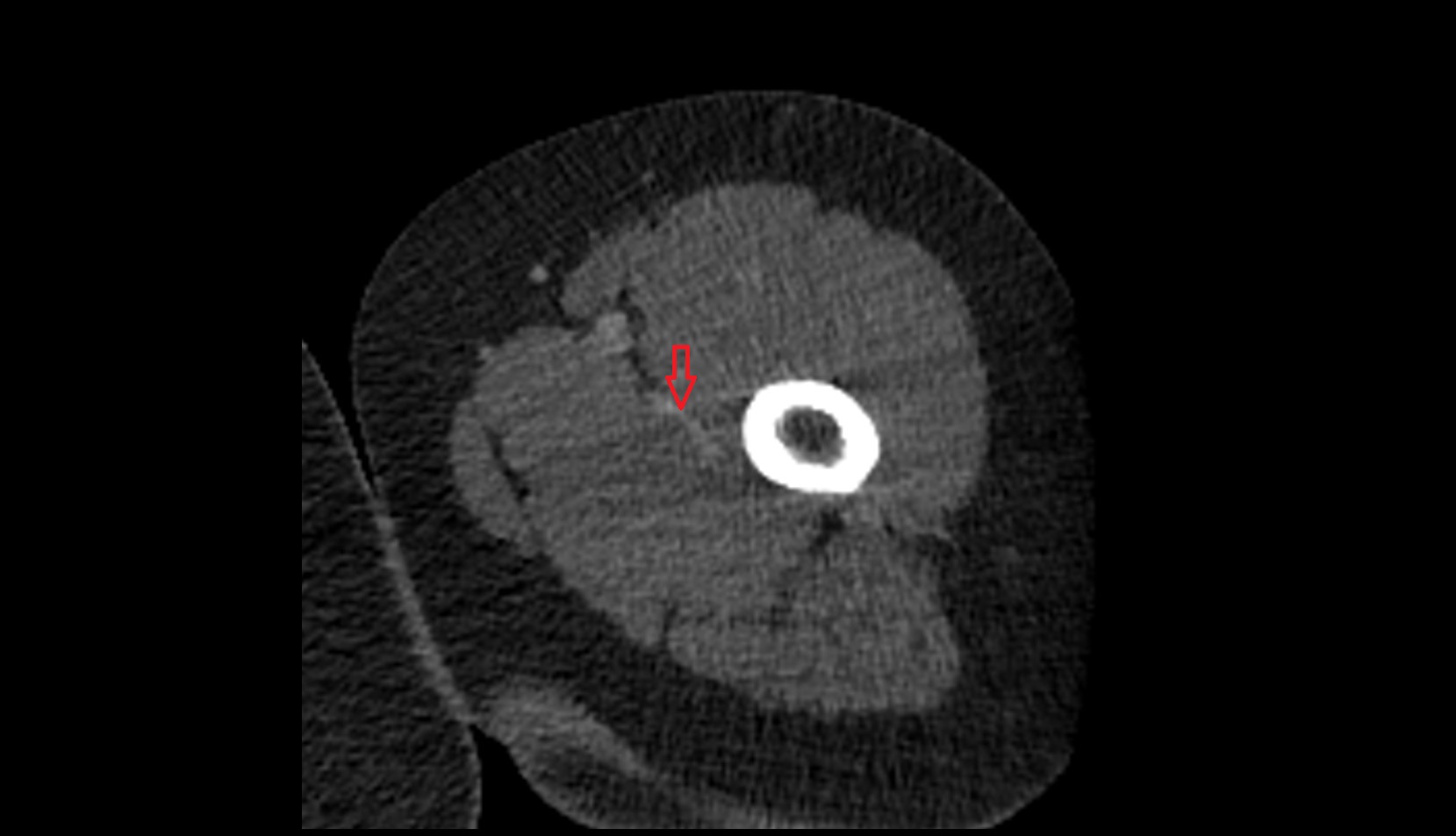 Profunda femoris (deep femoral) vein ct axial image