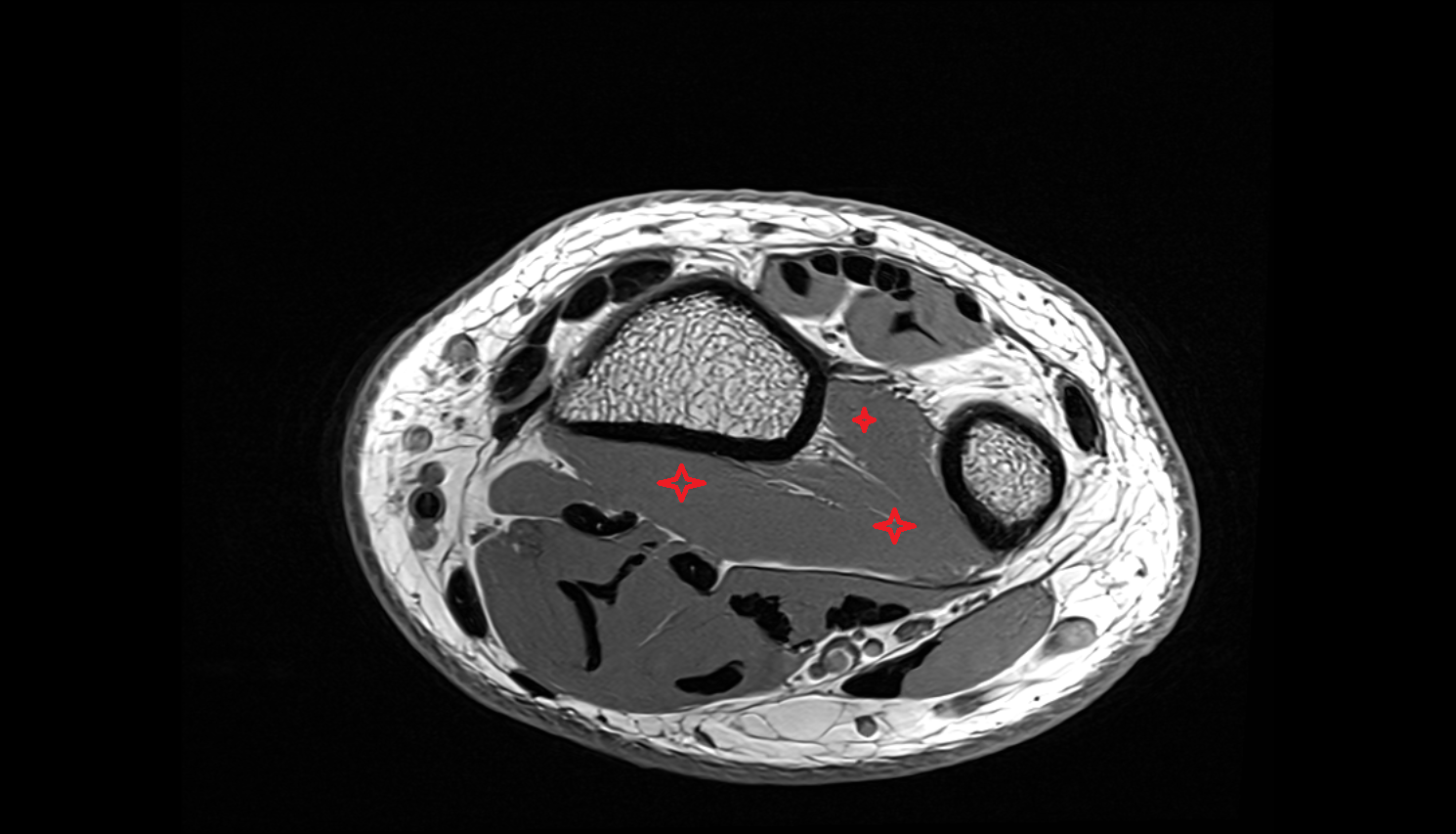 Pronator quadratus muscle  axial cross sectional anatomy 3T MRI AI enhanced radiology image-img-00000-00000
