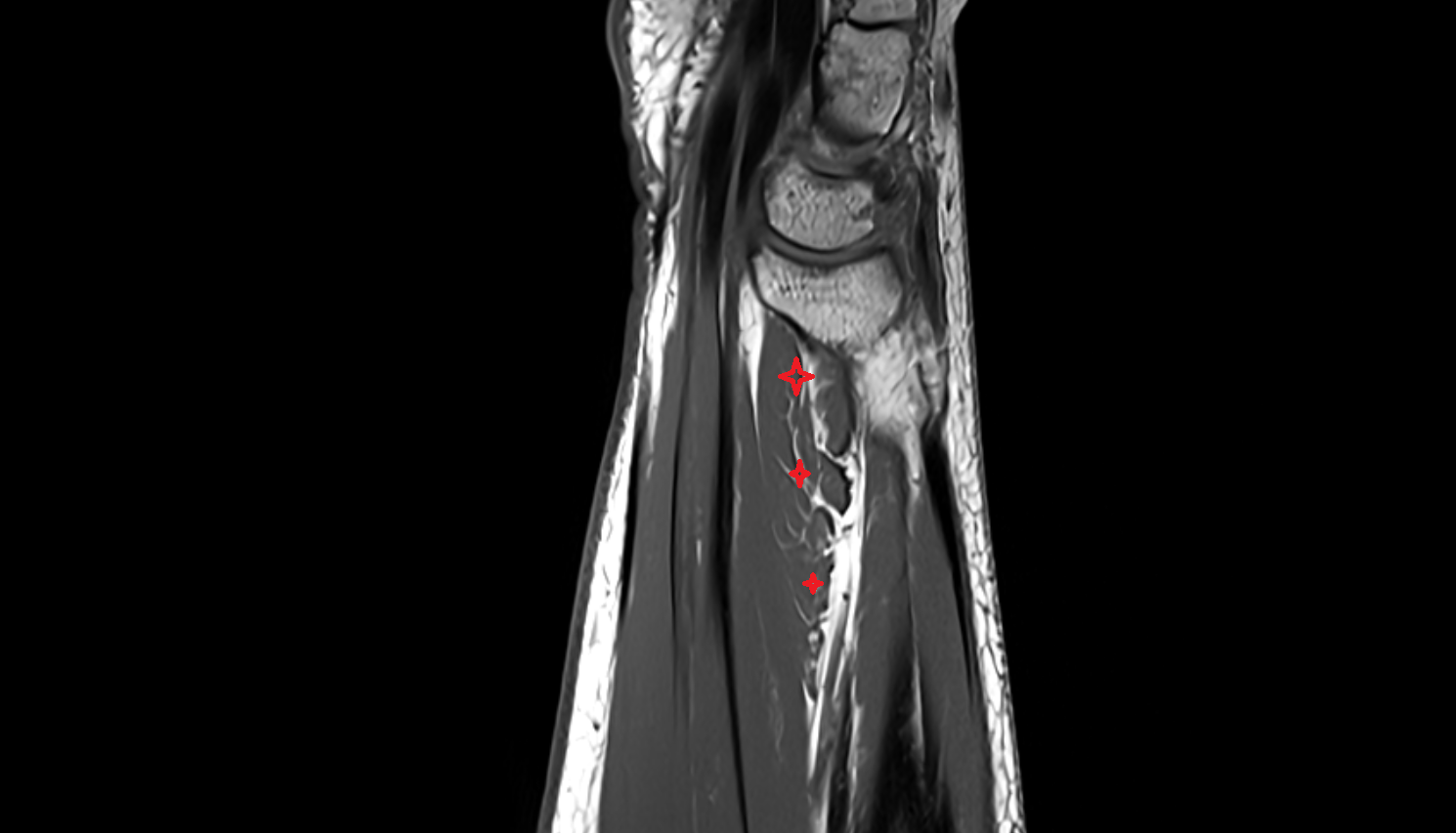 Pronator quadratus  muscle sag cross sectional anatomy 3T MRI AI enhanced radiology image-img-00000-00000