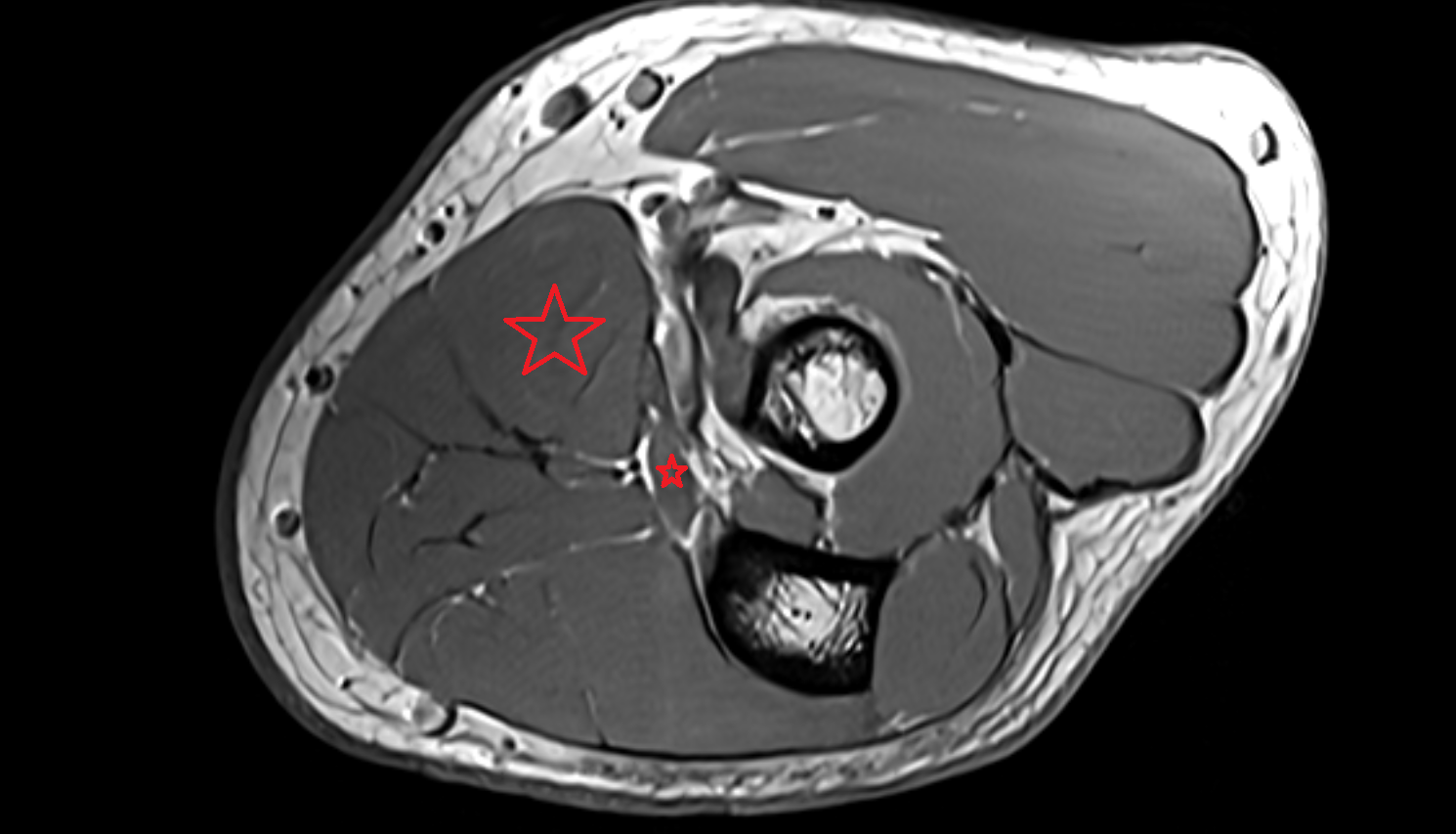 Pronator teres muscle axial cross sectional anatomy 3T MRI AI enhanced radiology image -img-00000-00000_00001