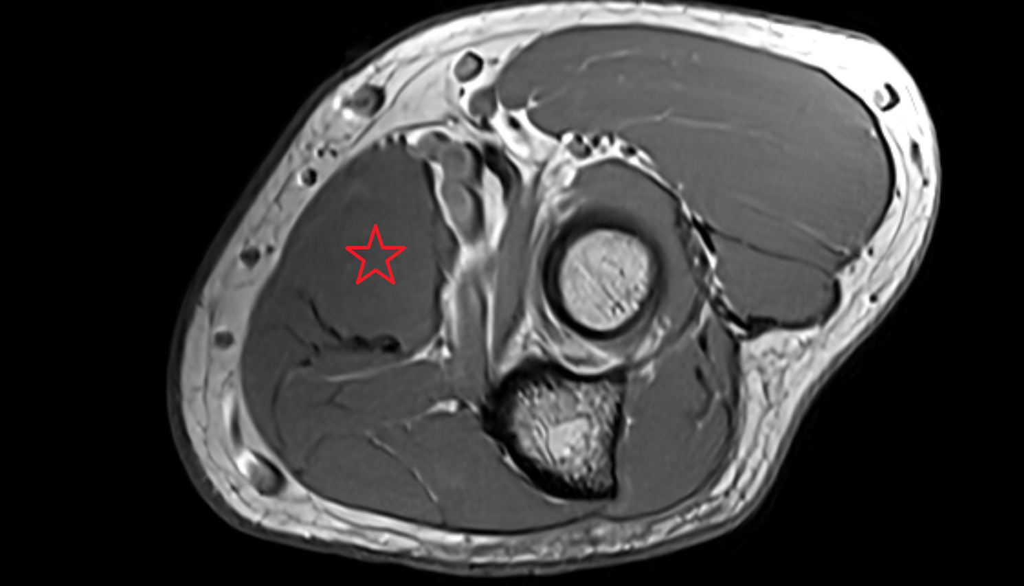 Pronator teres muscle axial cross sectional anatomy 3T MRI AI enhanced radiology image -img-00000-00000_00002