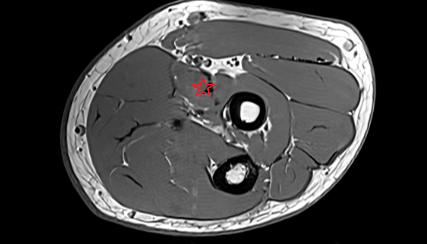 Pronator teres muscle axial cross sectional anatomy 3T MRI AI enhanced radiology image -img-00000-00000_00003