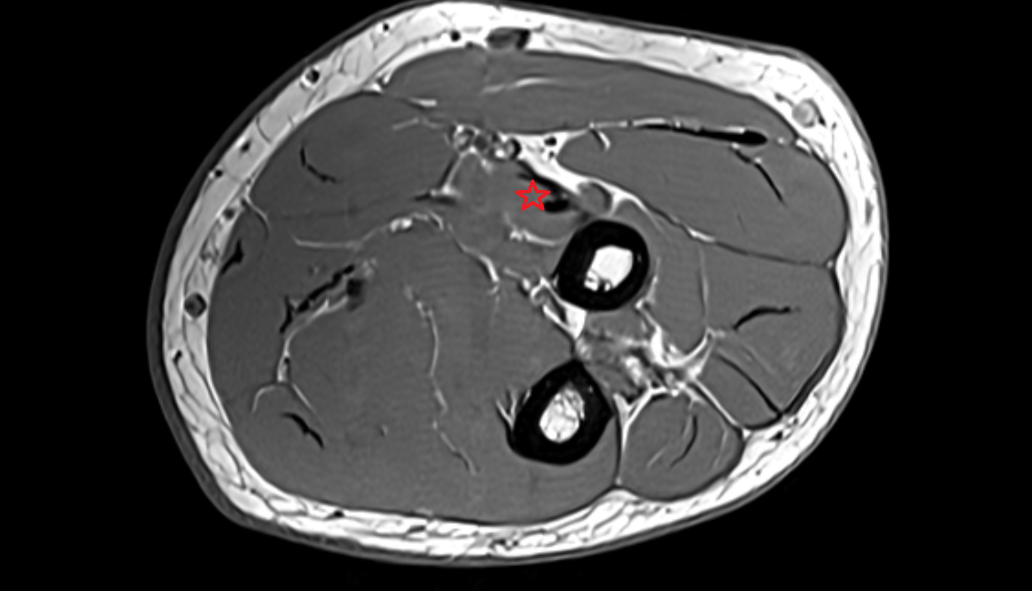 Pronator teres muscle axial cross sectional anatomy 3T MRI AI enhanced radiology image -img-00000-00000_00004
