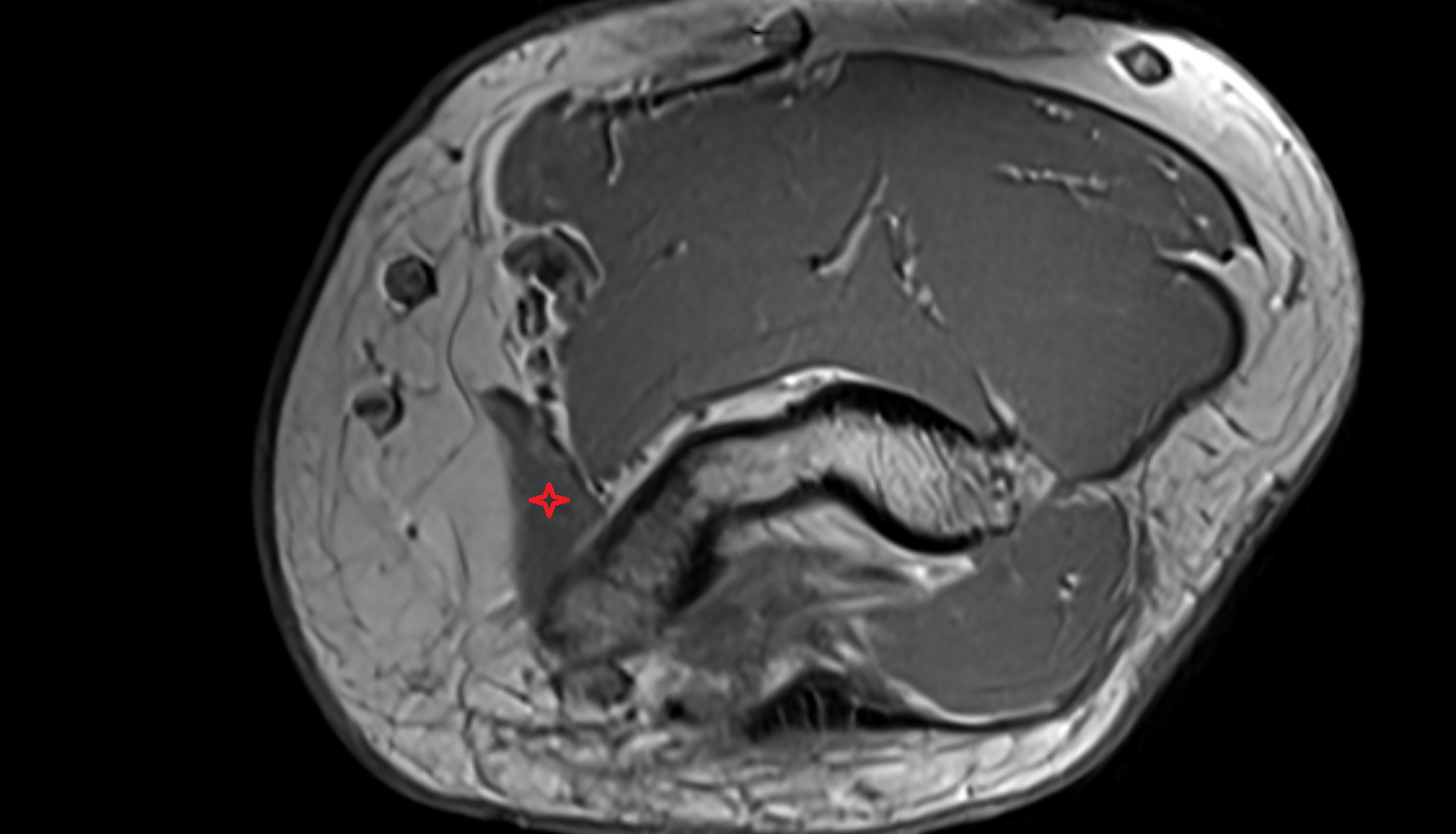 Pronator teres muscle (humeral head)  axial cross sectional anatomy 3T MRI AI enhanced radiology image -img-00000-00000