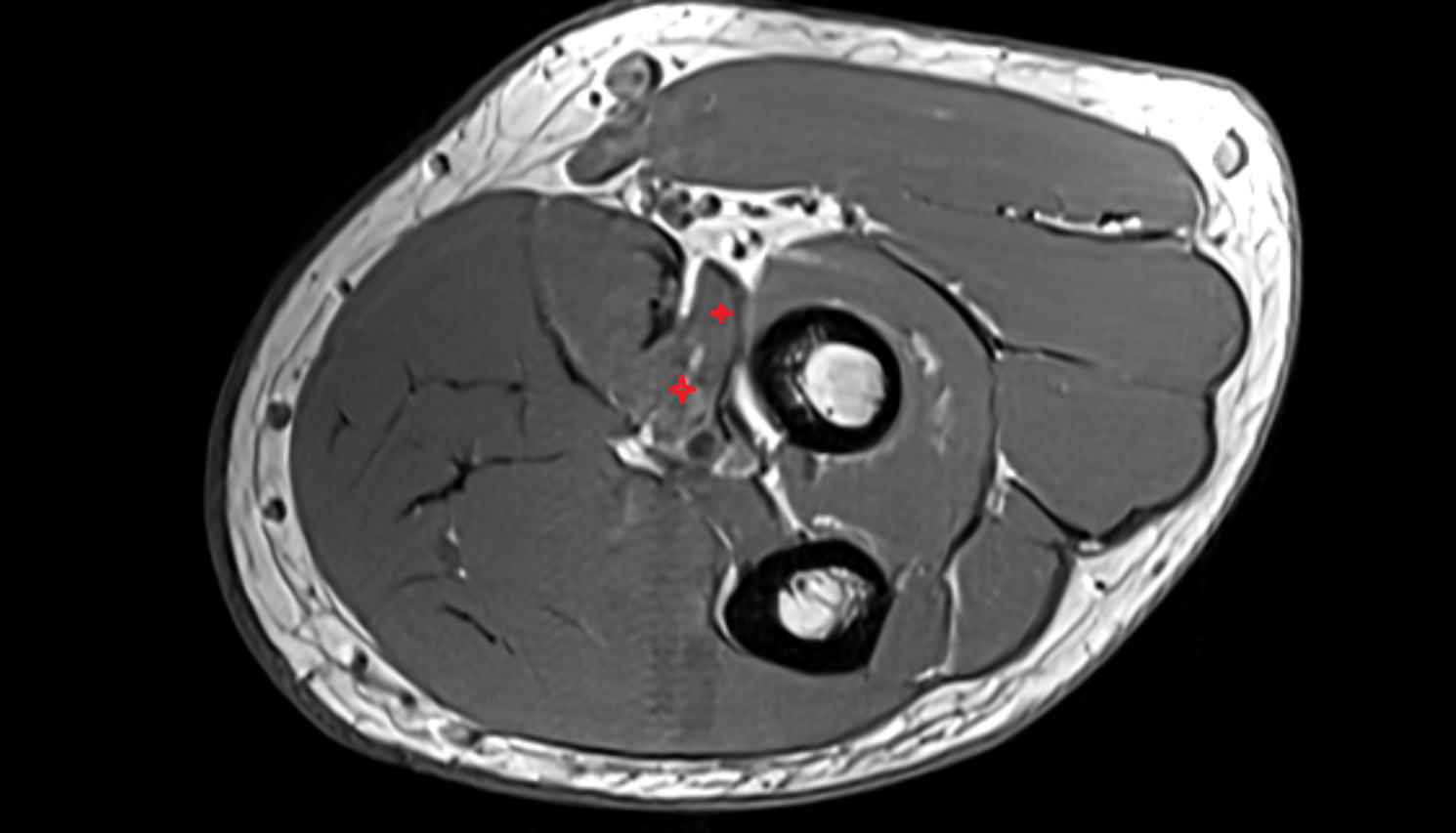 Pronator teres muscle ulnar head  axial cross sectional anatomy 3T MRI AI enhanced radiology image -img-00000-00000_00001