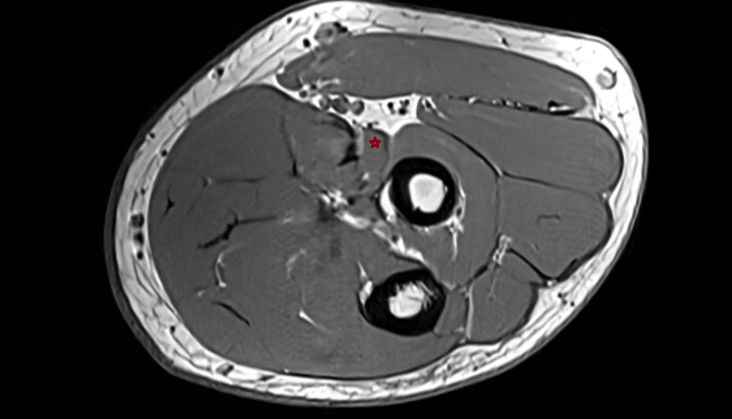 Pronator teres muscle ulnar head  axial cross sectional anatomy 3T MRI AI enhanced radiology image -img-00000-00000_00002