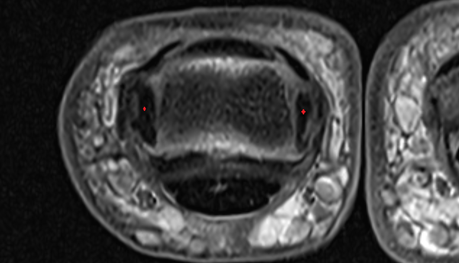 Proper collateral ligament HAND  MRI AXIAL image-img-00000-00000