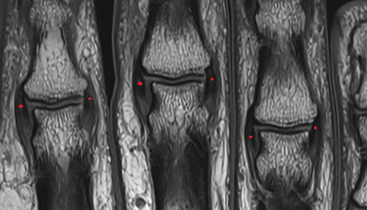 Proper collateral ligament HAND  MRI CORONAL image-img-00000-00000