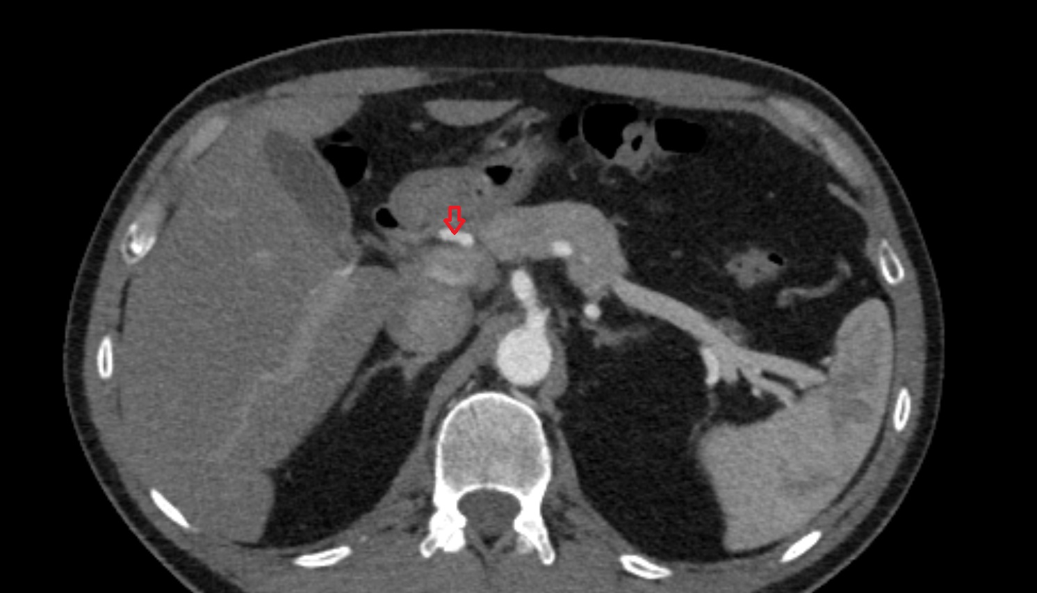 Proper hepatic artery CT axial   image -img-00000-00000