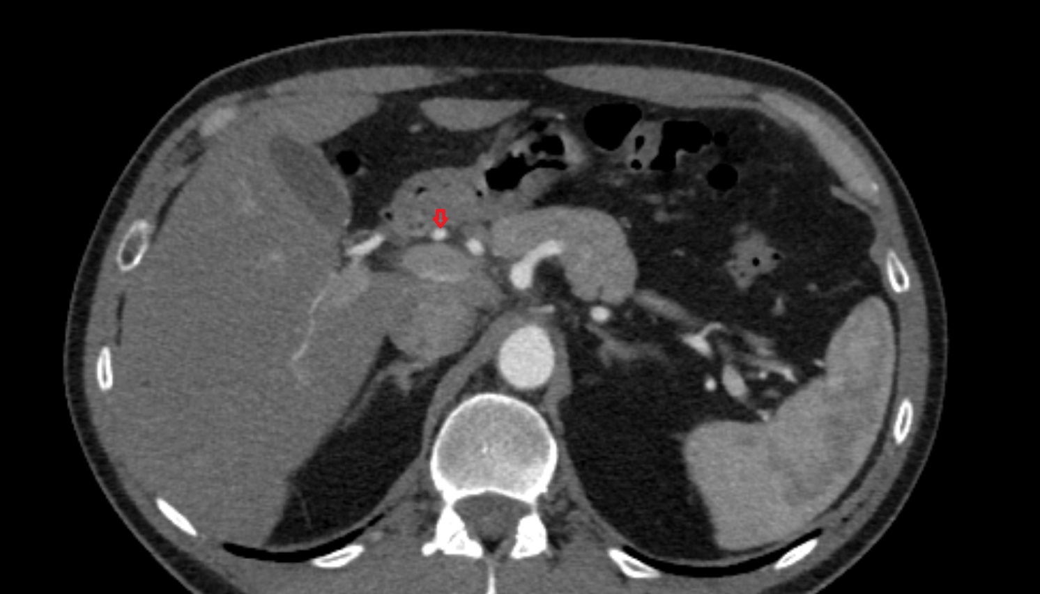 Proper hepatic artery CT axial   image -img-00000-00000_00001