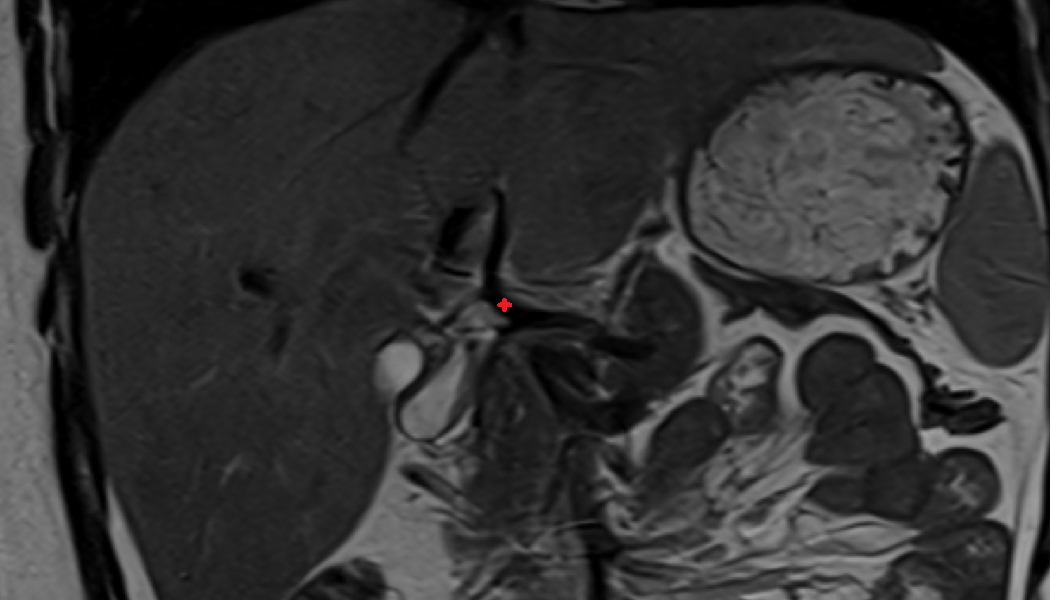 Proper hepatic artery anantomy MRI CORONAL  image -img-00000-00000