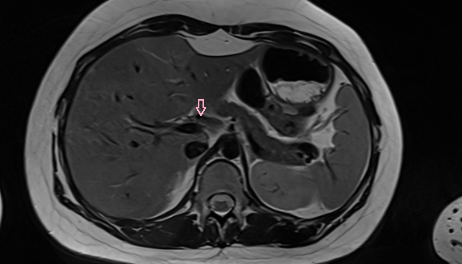 Proper hepatic artery anantomy MRI axial   image -img-00000-00000