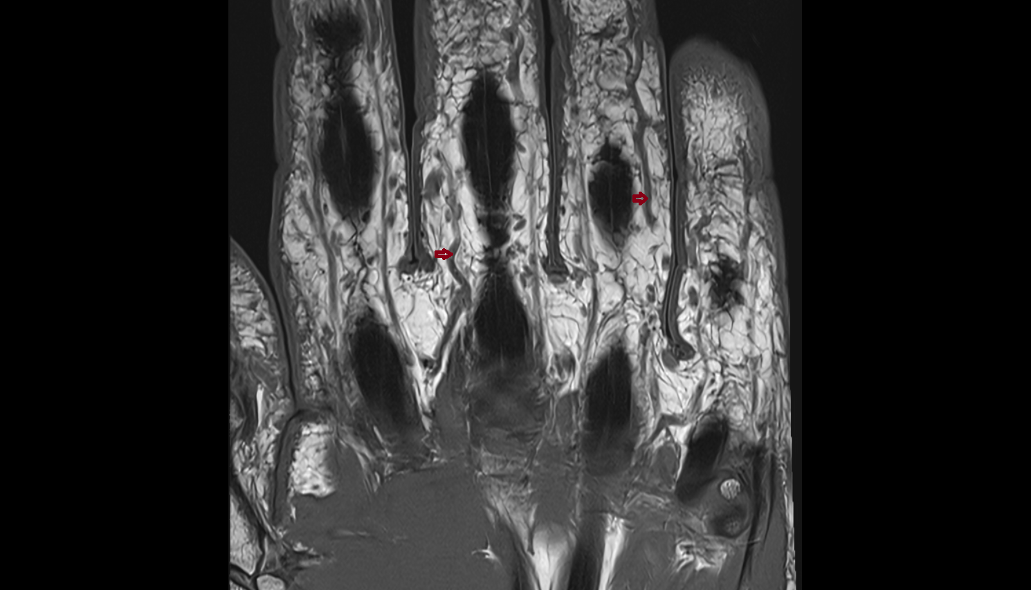 Proper palmar digital arteries  MRI coronal image-img-00000-00000