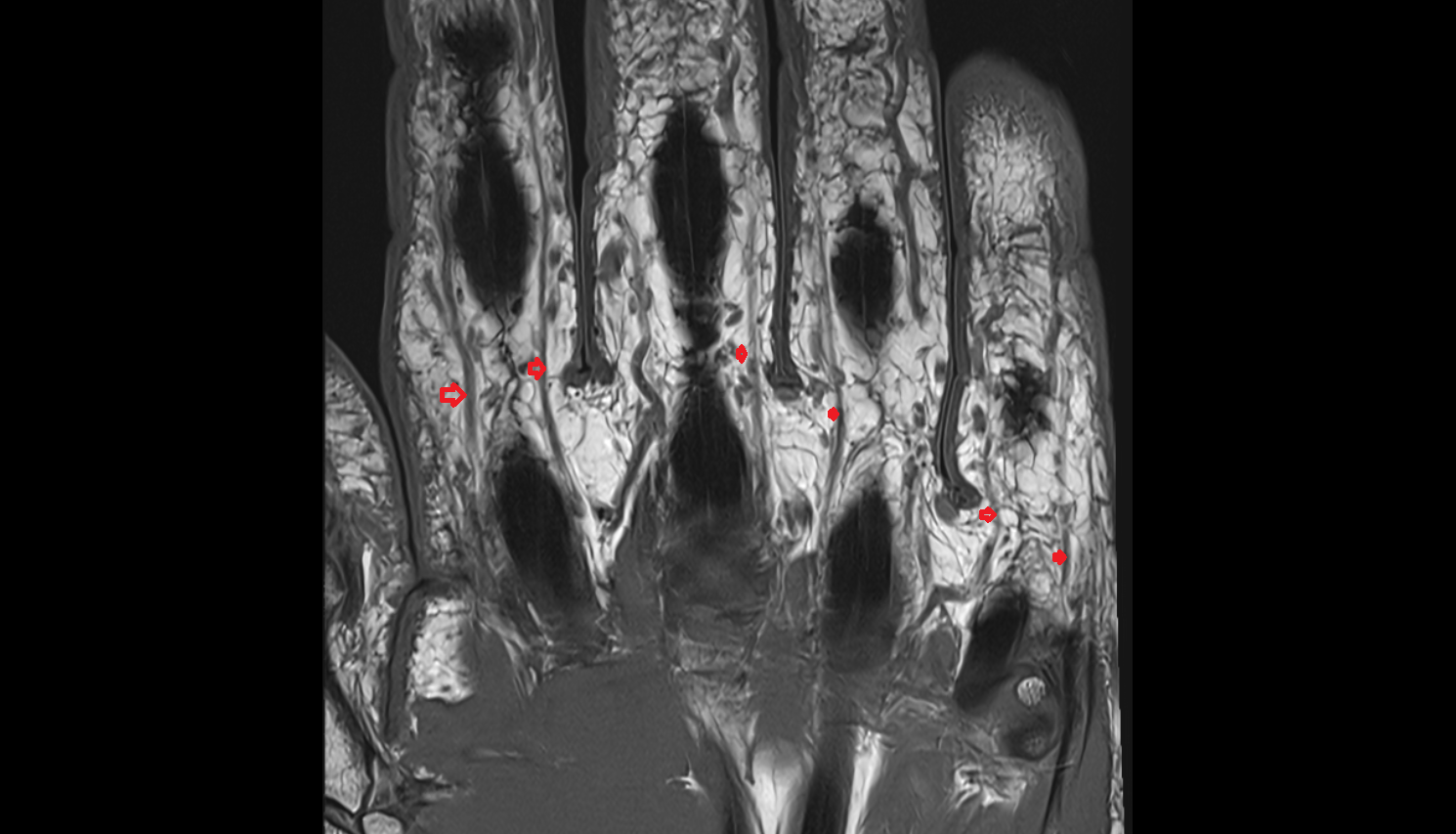 Proper palmar digital nerve  MRI coronal image-img-00000-00000