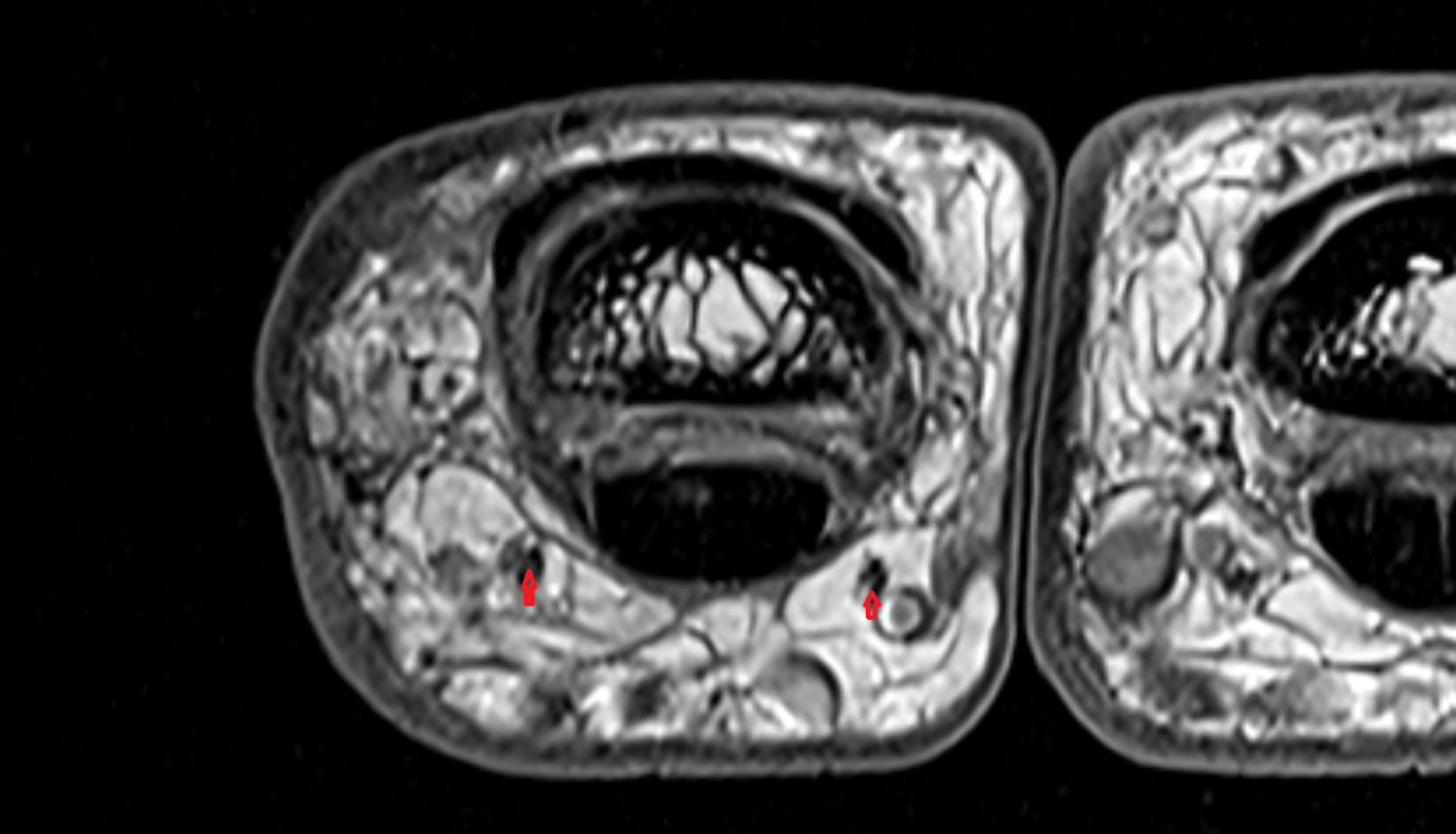 Proper palmar digital nerve  hand  MRI axial  image-img-00000-00000