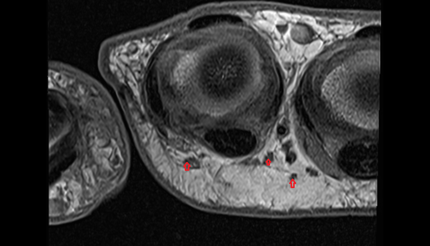 Proper palmar digital nerves axial cross sectional anatomy 3T MRI AI enhanced radiology image-img-00000-00000