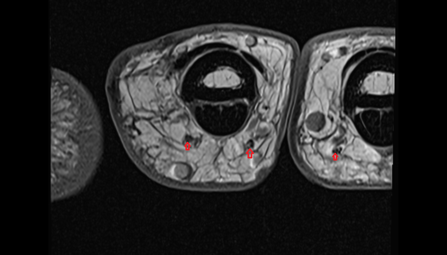 Proper palmar digital nerves axial cross sectional anatomy 3T MRI AI enhanced radiology image-img-00000-00000_00001