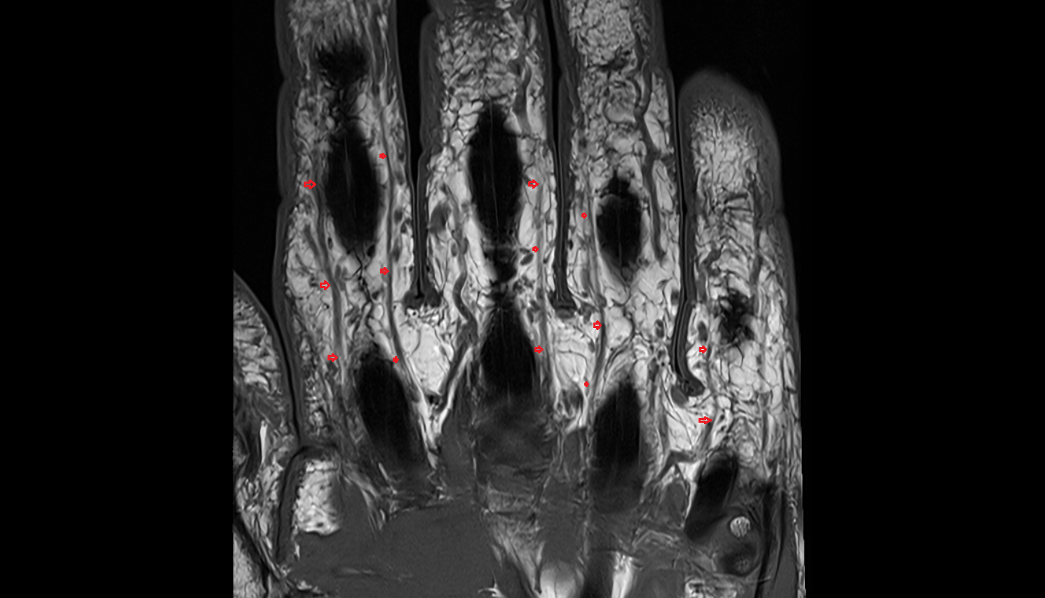 Proper palmar digital nerves coronal cross sectional anatomy 3T MRI AI enhanced radiology image-img-00000-00000