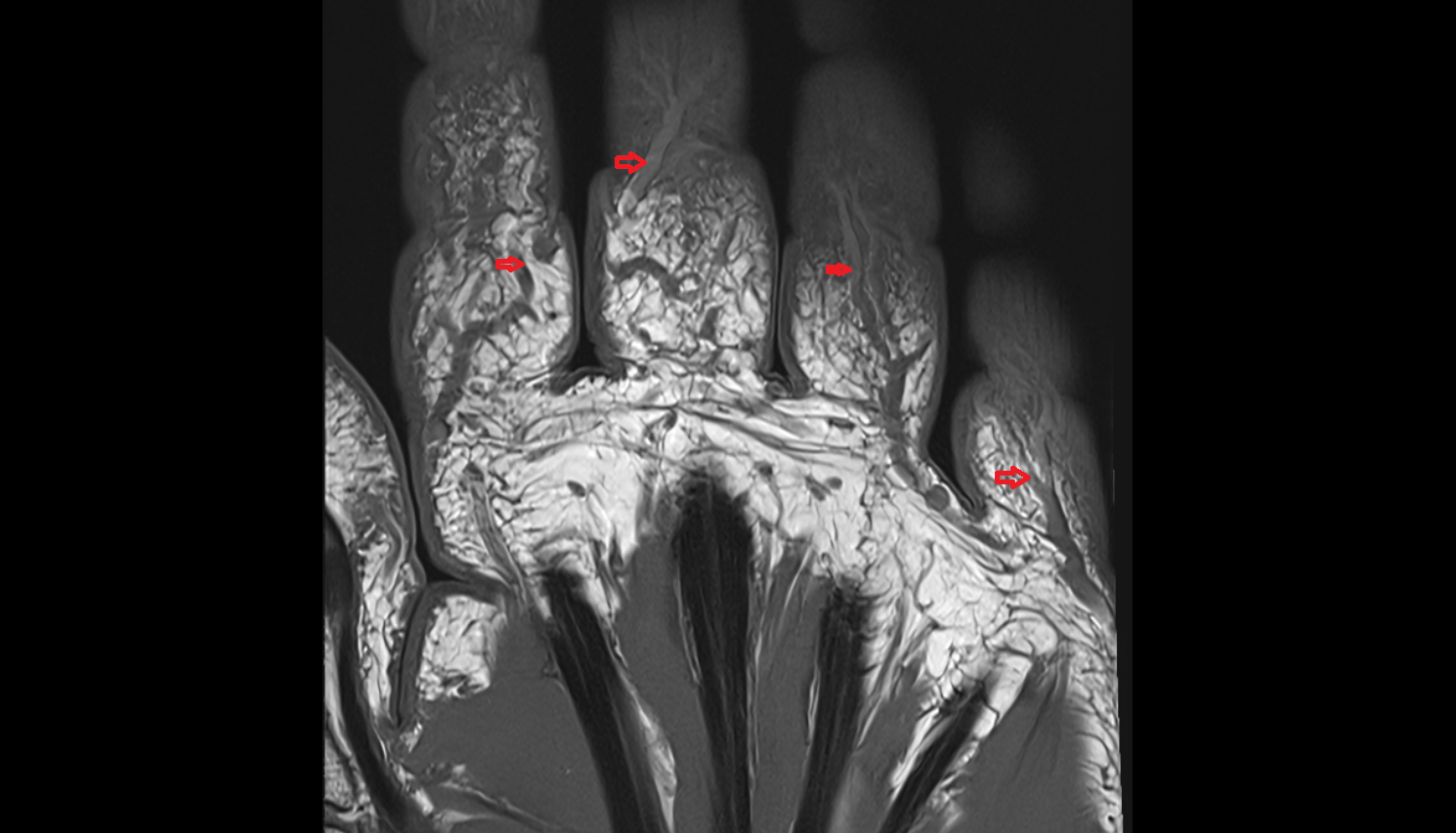 Proper palmar digital veins  MRI coronal image-img-00000-00000