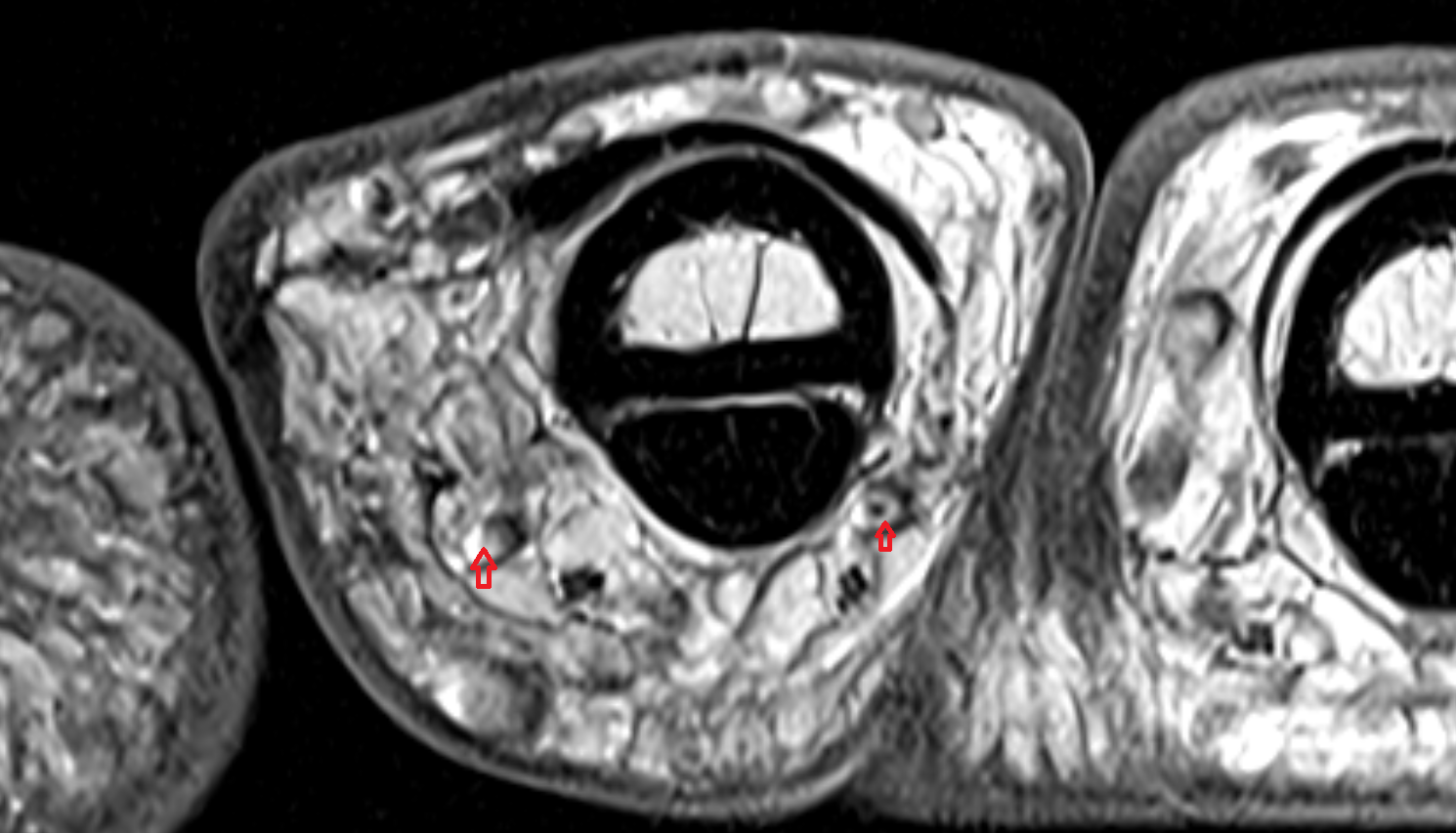 Proper palmar digital veins  hand  MRI axial  image-img-00000-00000