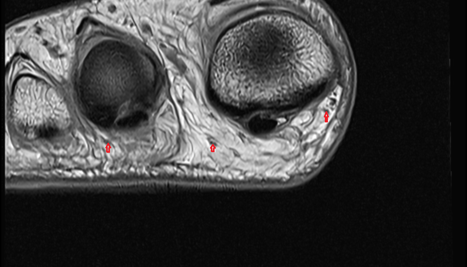 Proper plantar digital nerve of foot axial cross sectional anatomy 3T MRI AI enhanced radiology image-img-00000-00000