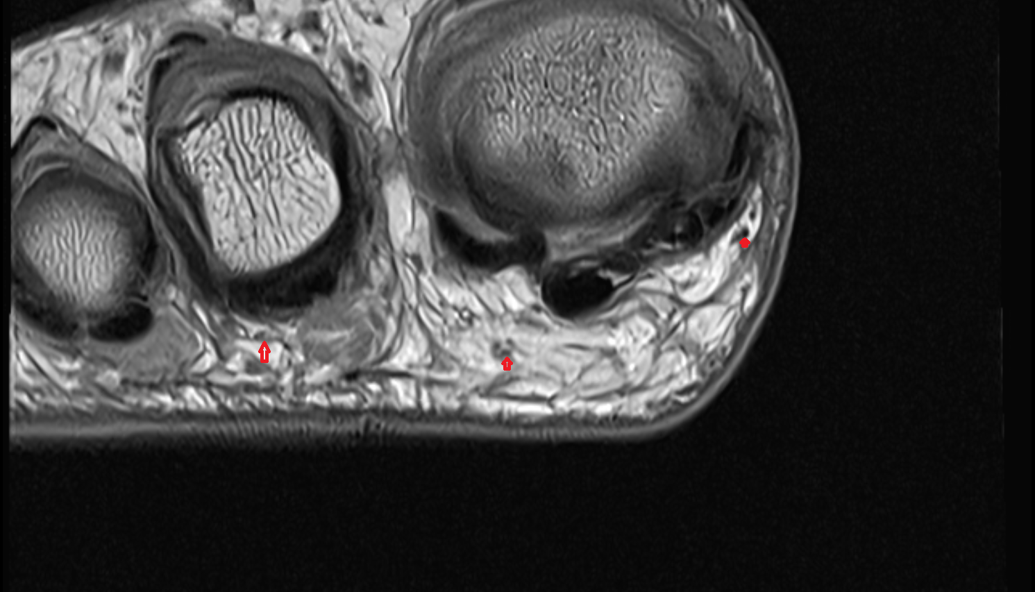 Proper plantar digital nerve of foot axial cross sectional anatomy 3T MRI AI enhanced radiology image-img-00000-00000_00001