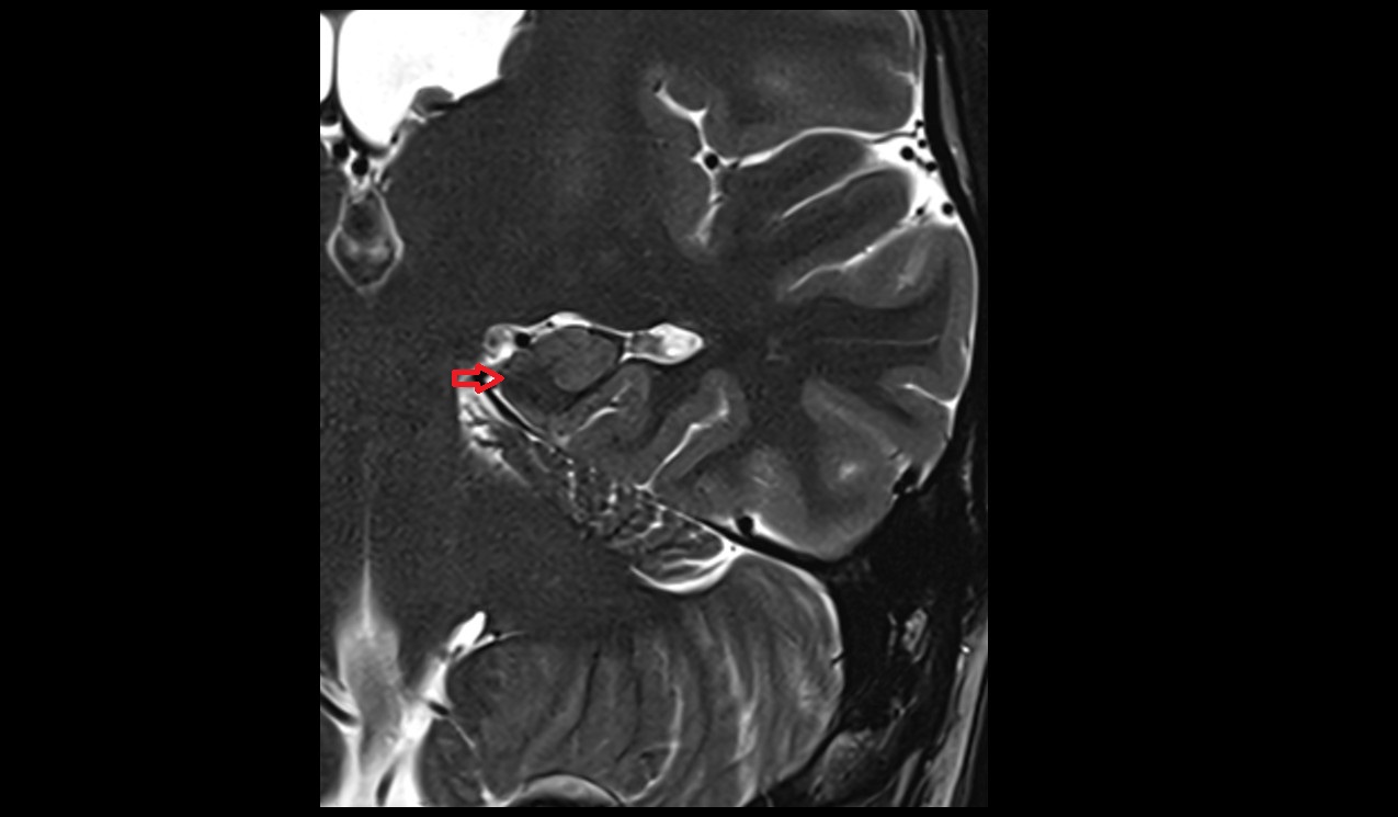 Prosubiculum mri 3t coronal image